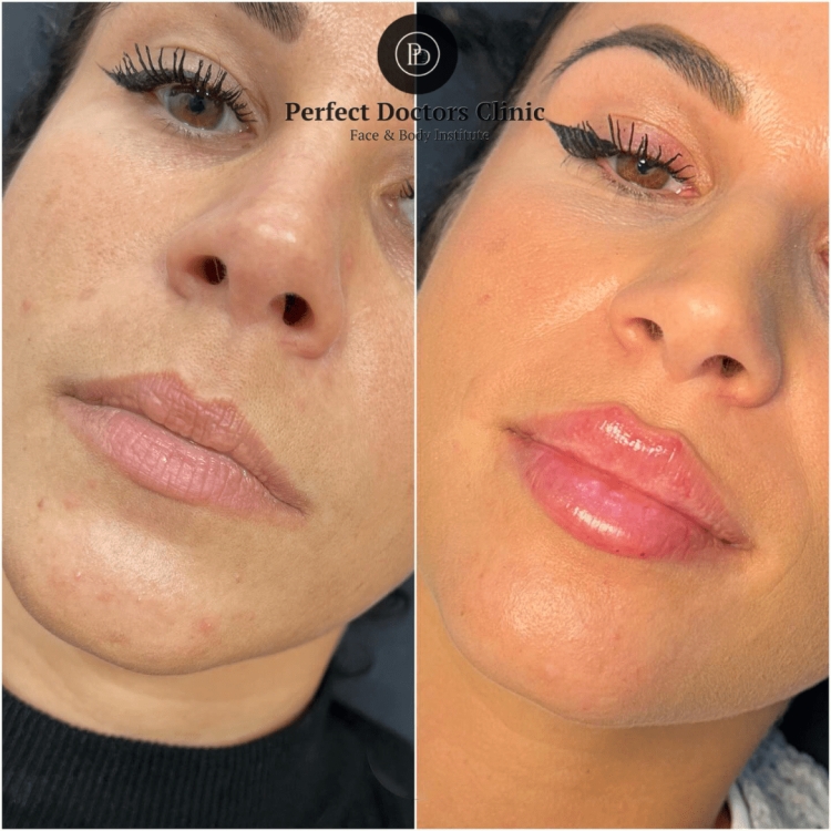 Why Follow-Up Appointments Are Crucial After Dermal fillers in Dubai