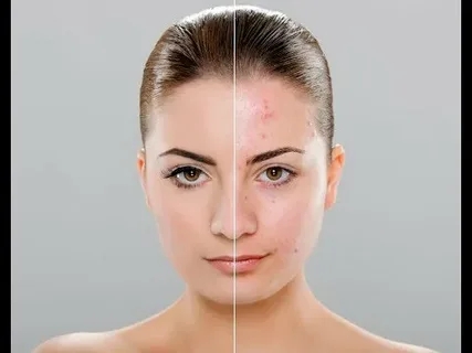 How to Use an Acne Scars Treatment Cream for Maximum Effectiveness