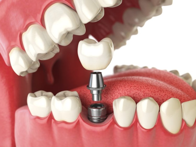 Procedures to Follow When a Dental Implant is Loose