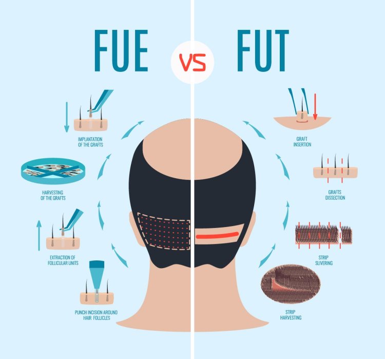 FUE vs FUT: Which Hair Transplant Technique is Right for You?