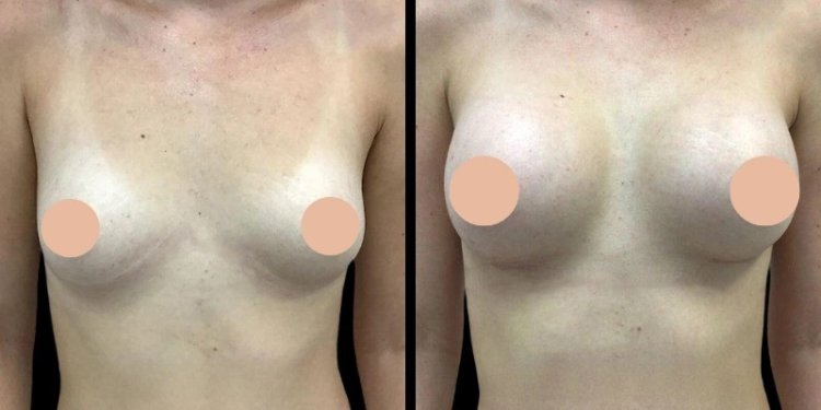 Breast Augmentation in Dubai: How to Maintain Beautiful, Long-Lasting Results