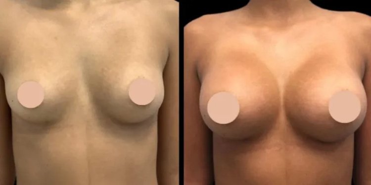 Breast Augmentation in Dubai: How Long Does the Procedure Last