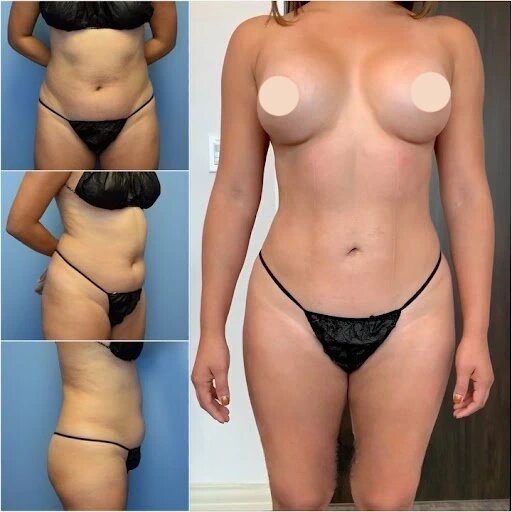 Best Body Contouring Surgeons in dubai: Combining Procedures for Enhanced Results